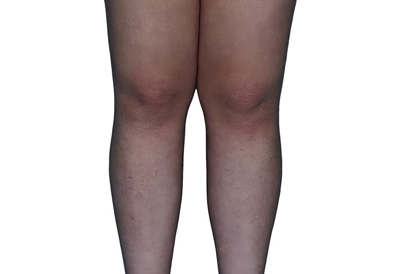 Actual 13-year-old female patient at Week 16 with improved atopic dermatitis on legs.
