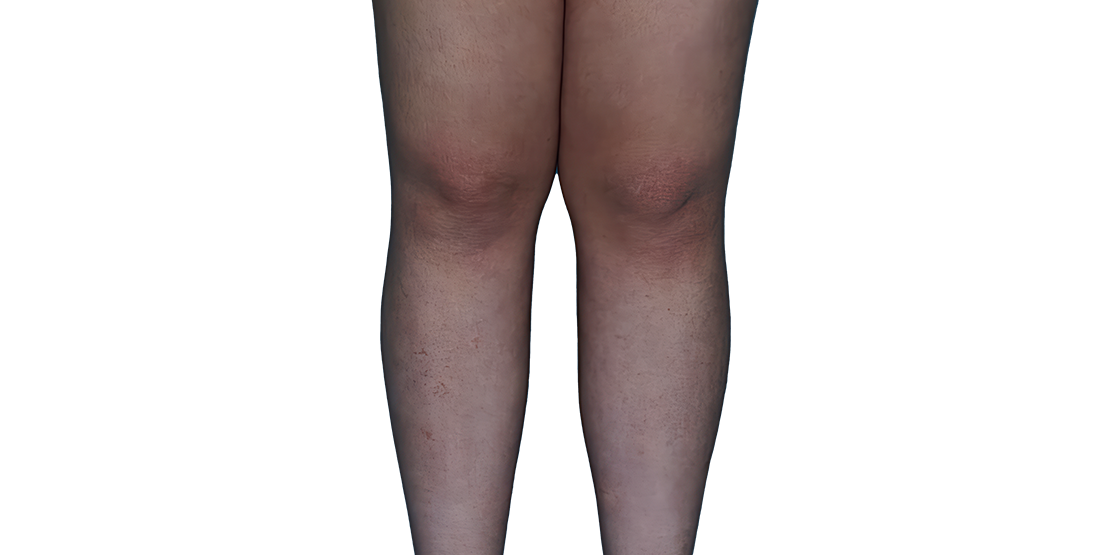 Actual 13-year-old female patient at Week 16 with improved atopic dermatitis on legs.