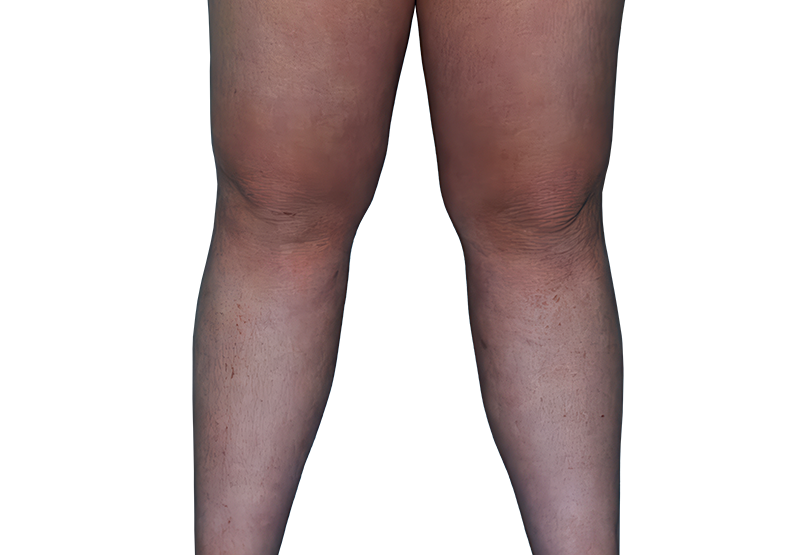 Actual 13-year-old female patient at baseline with atopic dermatitis on legs.