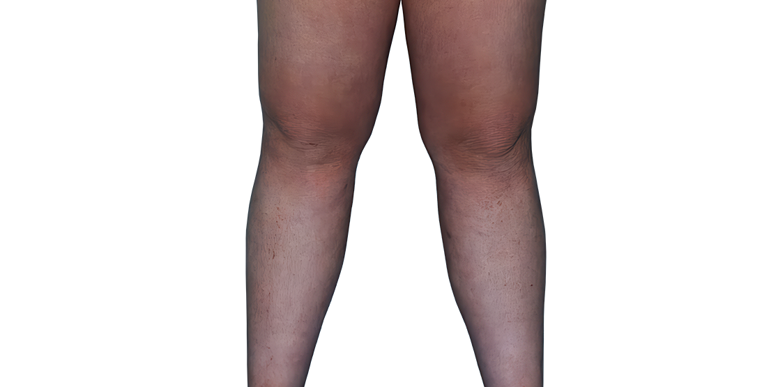Actual 13-year-old female patient at baseline with atopic dermatitis on legs.