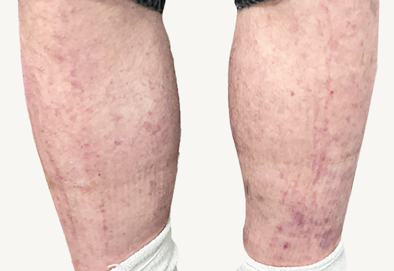 Male patient at Week 16 with improved atopic dermatitis on the shins.