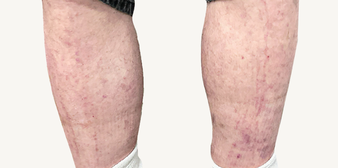 Male patient at Week 16 with improved atopic dermatitis on the shins.