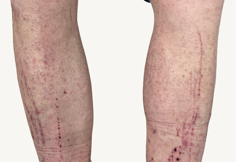 Male patient at baseline with atopic dermatitis on the shins.