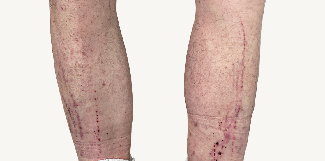 Male patient at baseline with atopic dermatitis on the shins.