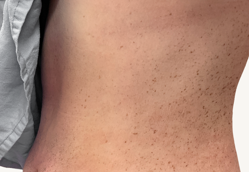 Actual 23-year-old male patient at Week 16 with improved atopic dermatitis on back of neck.