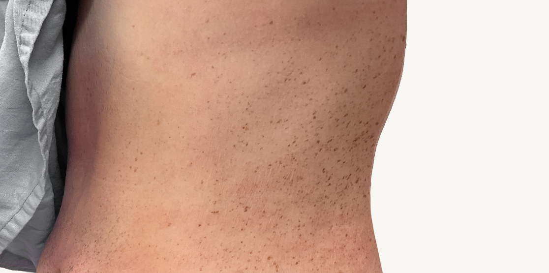 Actual 23-year-old male patient at Week 16 with improved atopic dermatitis on back of neck.