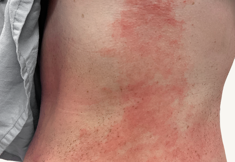 Actual 23-year-old male patient at baseline with atopic dermatitis on back of neck.