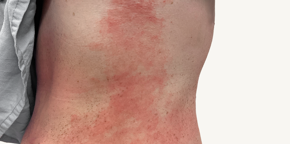 Actual 23-year-old male patient at baseline with atopic dermatitis on back of neck.