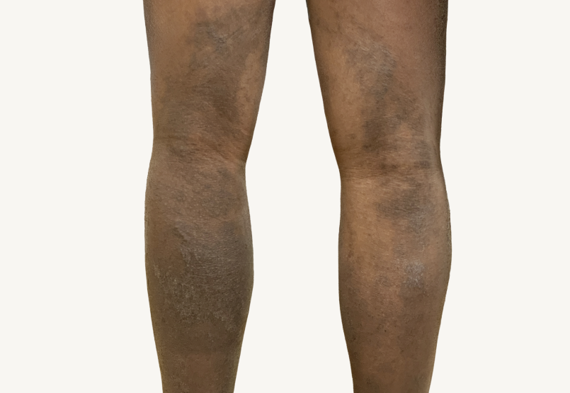 Patient at Week 16 with improved atopic dermatitis on the back of the legs.
