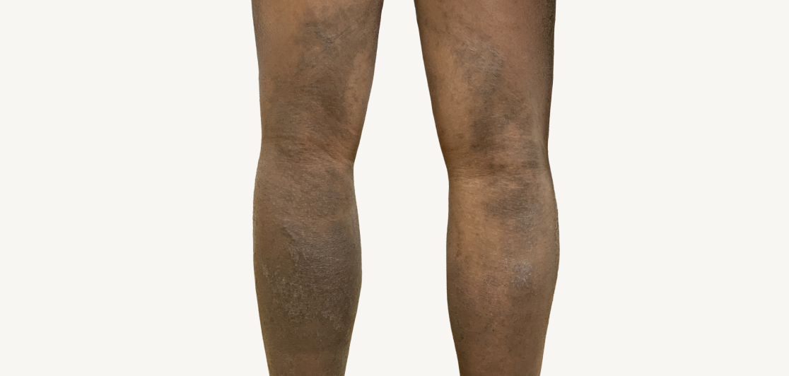 Patient at Week 16 with improved atopic dermatitis on the back of the legs.