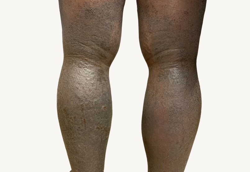 Patient at baseline with atopic dermatitis on the back of the legs.
