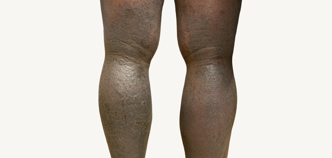 Patient at baseline with atopic dermatitis on the back of the legs.