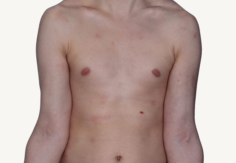 Actual 42-year-old male patient at Week 16 with improved atopic dermatitis on chest.