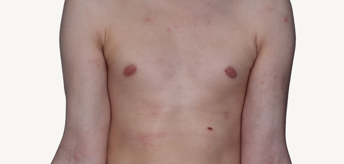 Actual 42-year-old male patient at Week 16 with improved atopic dermatitis on chest.