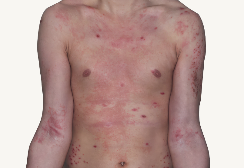 Actual 42-year-old male patient at baseline with atopic dermatitis on chest.