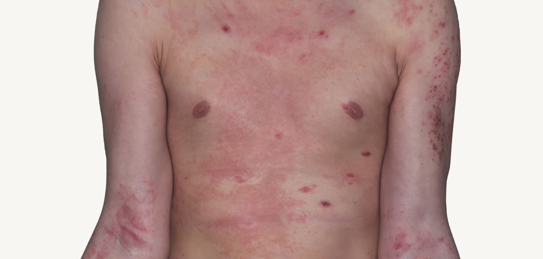 Actual 42-year-old male patient at baseline with atopic dermatitis on chest.
