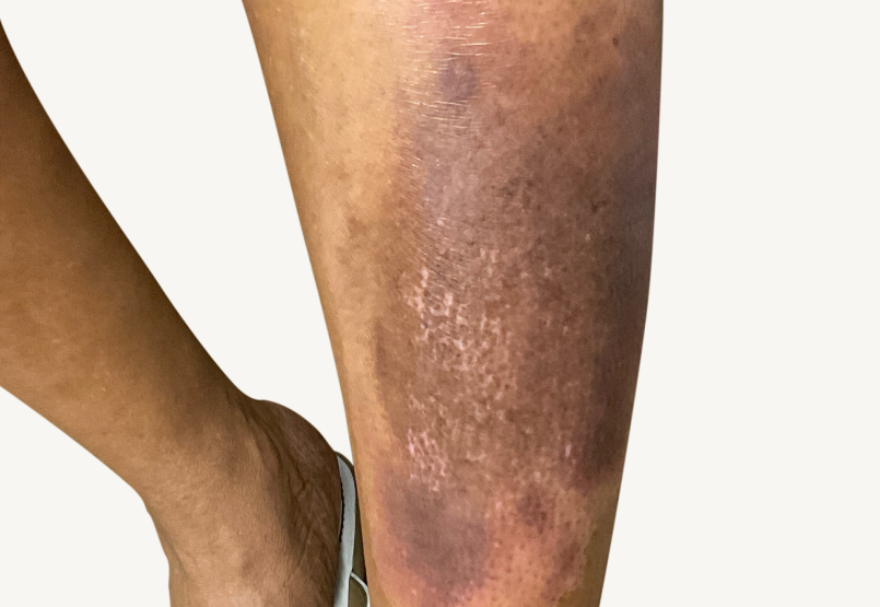 Actual 42-year-old male patient at baseline with atopic dermatitis on chest.
