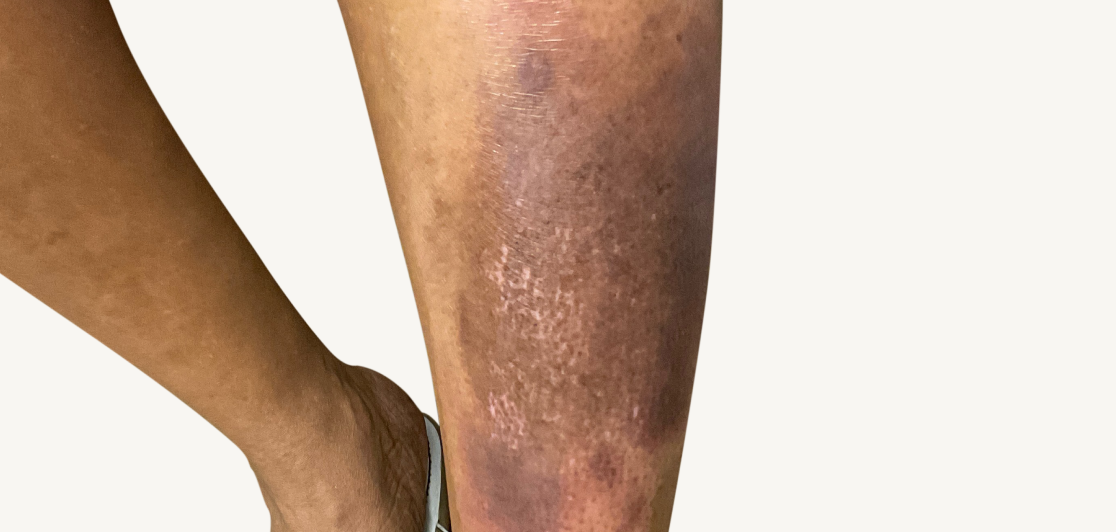 Actual 42-year-old male patient at baseline with atopic dermatitis on chest.
