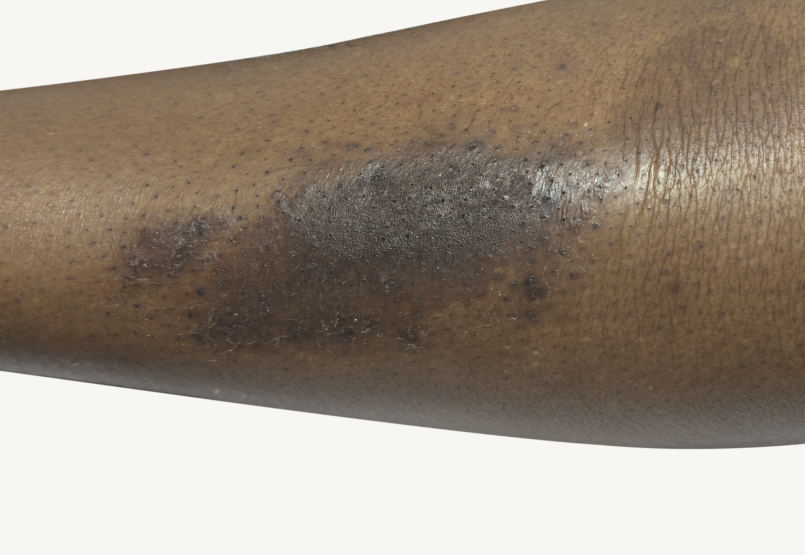 Actual 42-year-old male patient at Week 16 with improved atopic dermatitis on back and arms.