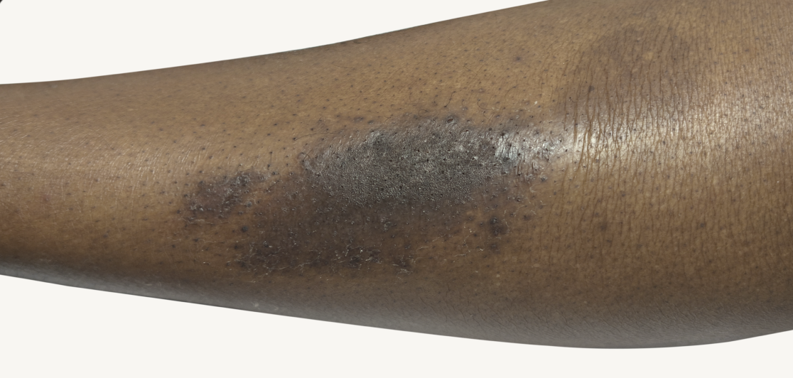 Actual 42-year-old male patient at Week 16 with improved atopic dermatitis on back and arms.