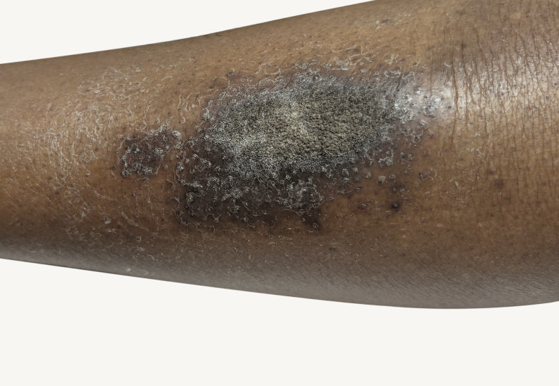Actual 42-year-old male patient at baseline with atopic dermatitis on back and arms.
