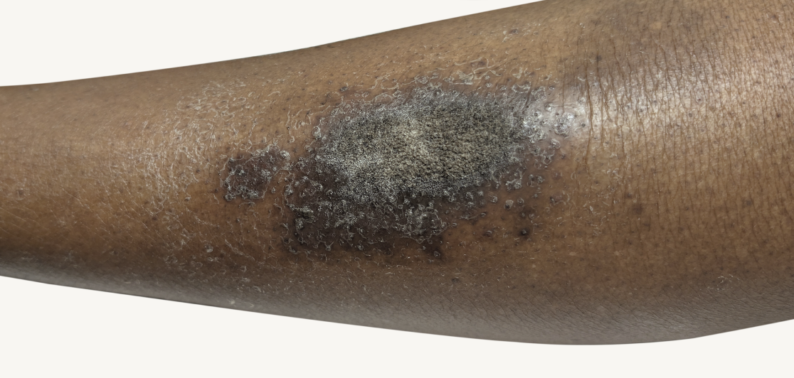 Actual 42-year-old male patient at baseline with atopic dermatitis on back and arms.