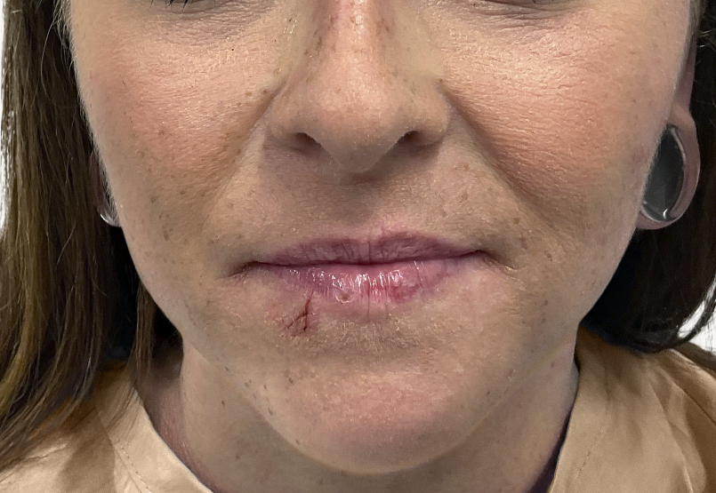 Female patient at Week 16 with improved atopic dermatitis on the face.