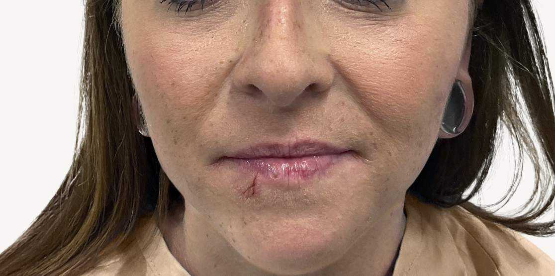 Female patient at Week 16 with improved atopic dermatitis on the face.