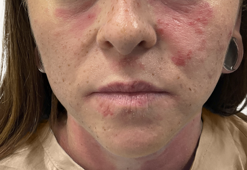 Female patient at baseline with atopic dermatitis on the face.