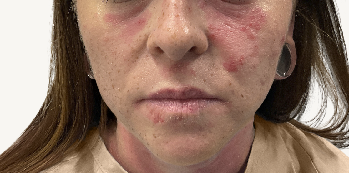 Female patient at baseline with atopic dermatitis on the face.