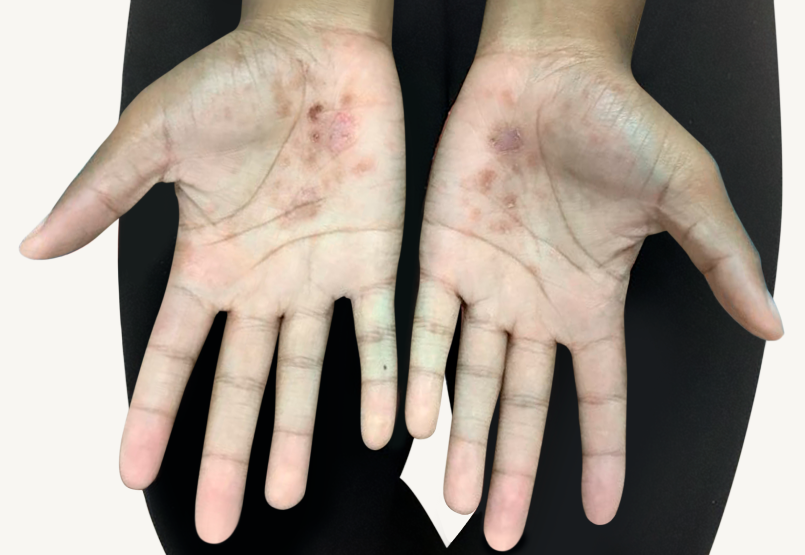 Patient at baseline with atopic dermatitis on the hands.