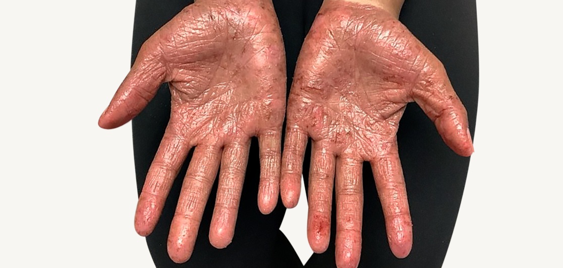 Patient at baseline with atopic dermatitis on the hands.