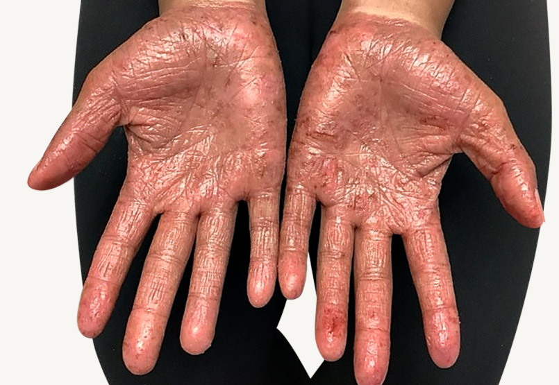 Patient at Week 16 with improved atopic dermatitis on the hands.