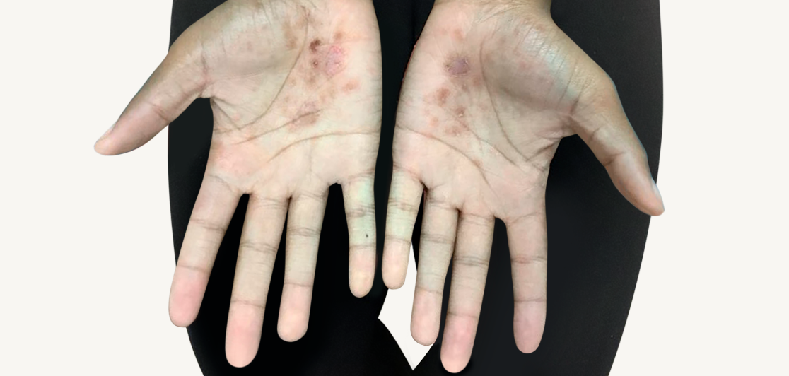 Patient at Week 16 with improved atopic dermatitis on the hands.