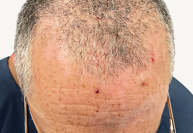 Actual 42-year-old male patient at Week 16 with improved atopic dermatitis on back and arms.