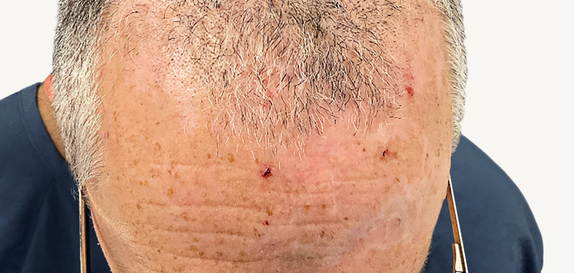 Actual 42-year-old male patient at Week 16 with improved atopic dermatitis on back and arms.