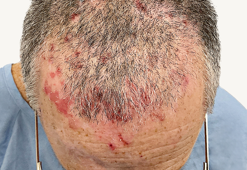 Actual 42-year-old male patient at baseline with atopic dermatitis on back and arms.