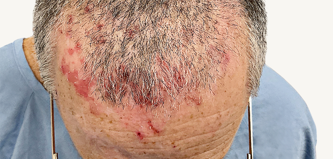 Actual 42-year-old male patient at baseline with atopic dermatitis on back and arms.