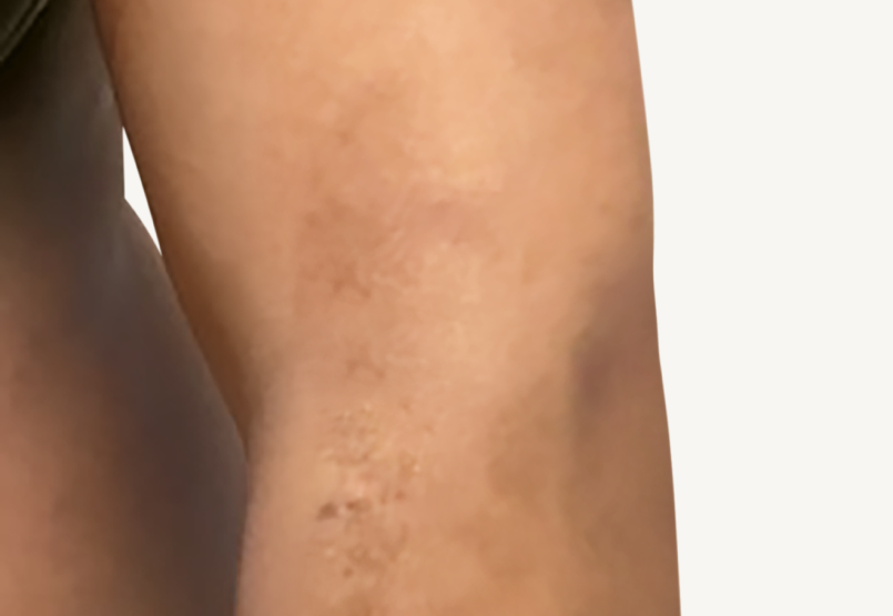 Patient at Week 16 with improved atopic dermatitis on the arm.