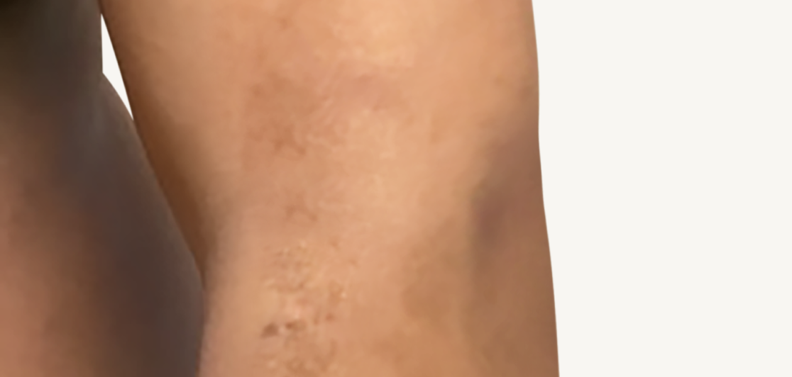 Patient at Week 16 with improved atopic dermatitis on the arm.