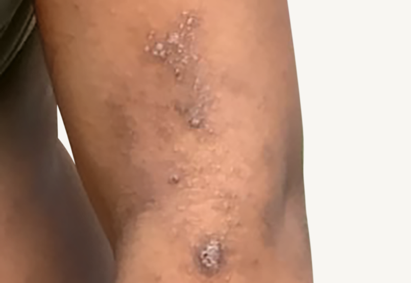 Patient at baseline with atopic dermatitis on the arm.