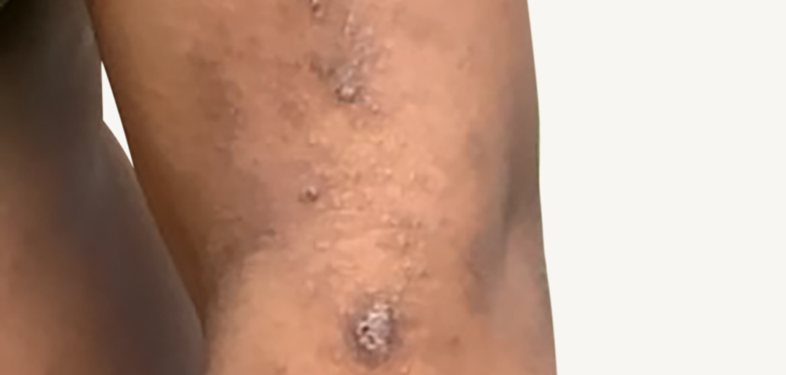 Patient at baseline with atopic dermatitis on the arm.