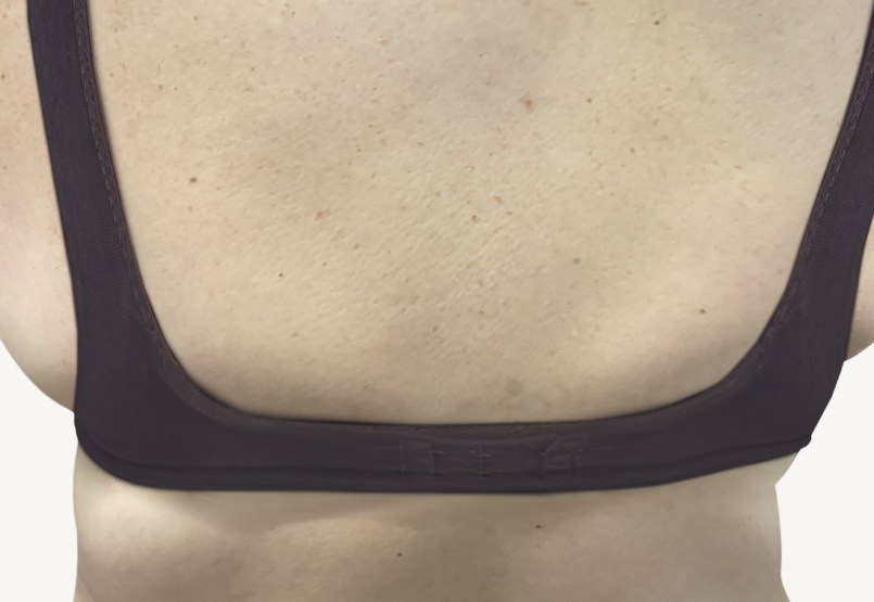 Female patient at Week 16 with improved atopic dermatitis on the back.