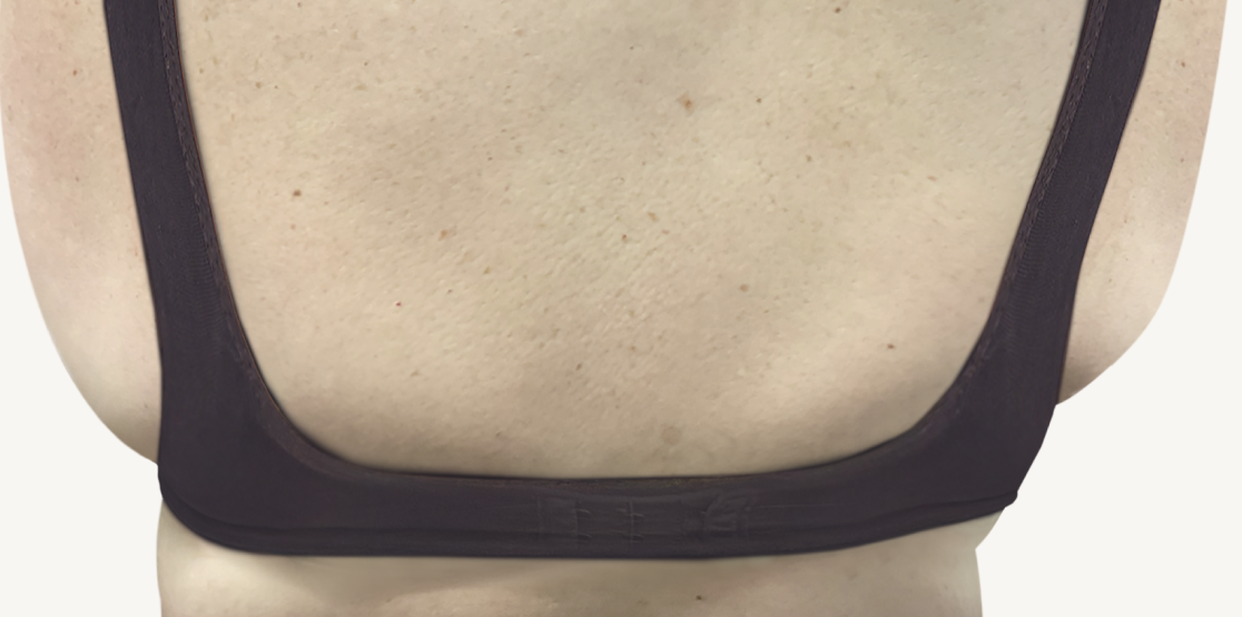 Female patient at Week 16 with improved atopic dermatitis on the back.
