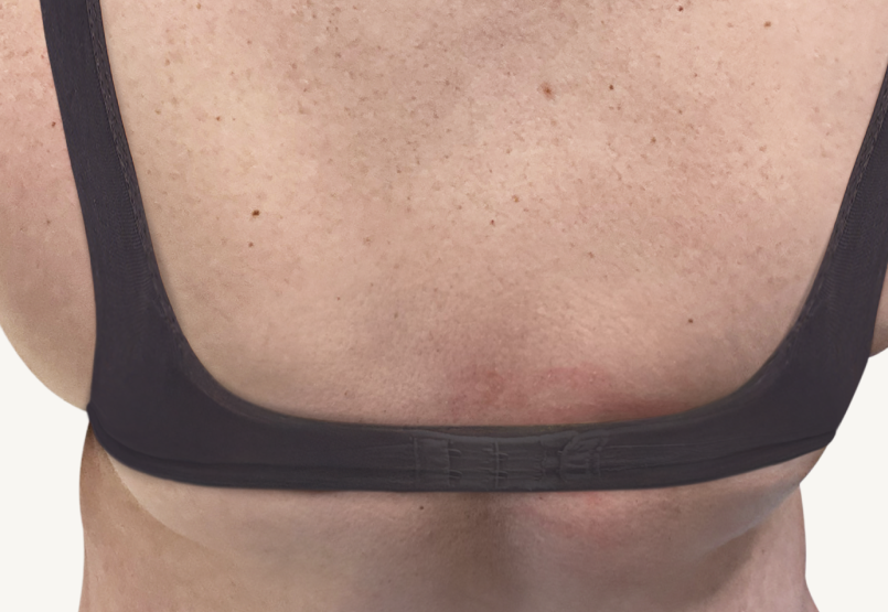 Female patient at baseline with atopic dermatitis on the back.
