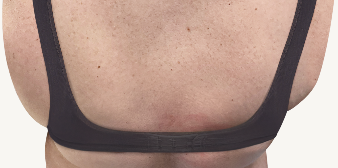 Female patient at baseline with atopic dermatitis on the back.