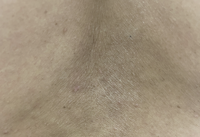 Patient at Week 16 with healed prurigo nodularis nodules on the back.