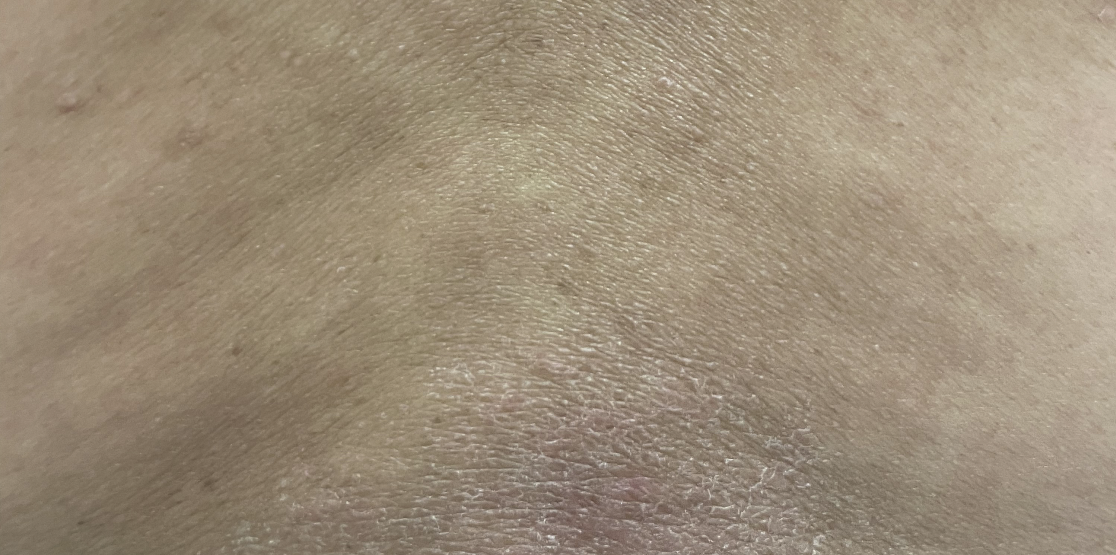 Patient at Week 16 with healed prurigo nodularis nodules on the back.