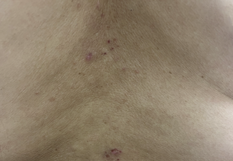 Patient at baseline with prurigo nodularis nodules on the back.