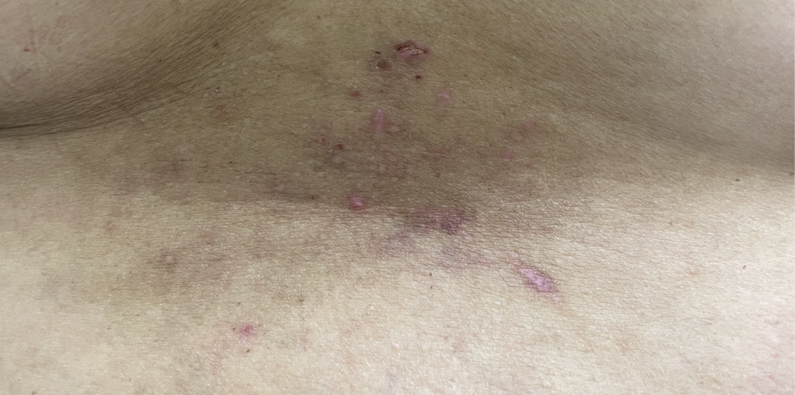 Patient at baseline with prurigo nodularis nodules on the back.
